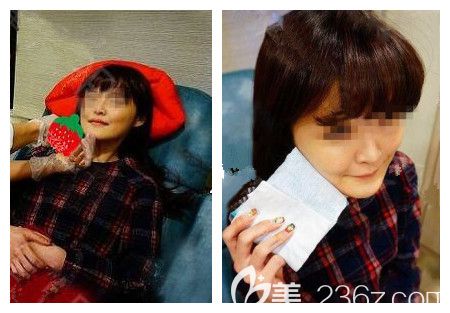 医生十几分钟瘦脸注射后冰敷 医生十几分钟瘦脸注射后冰敷