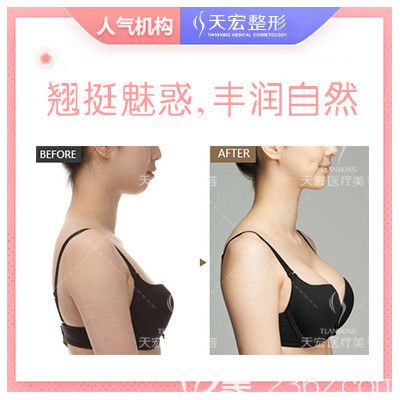 张家口天宏自体脂肪动态丰胸案例