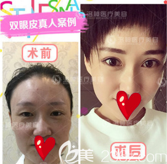 烟台洛神全切双眼皮案例