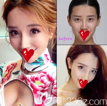 烟台鹏爱整形医院全切双眼皮案例