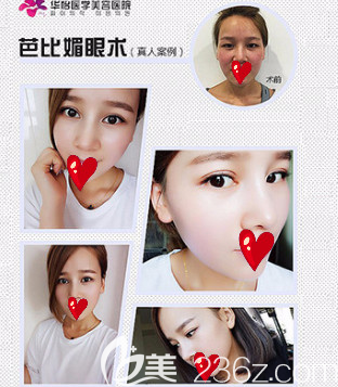 烟台华怡全切双眼皮案例