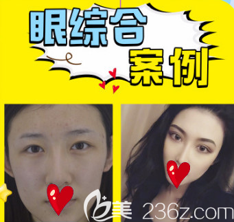 烟台王玉珍全切双眼皮案例