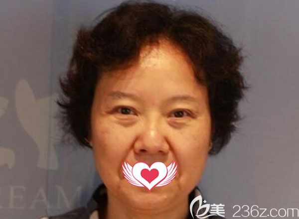 在昆明梦想做内切去眼袋手术前 在昆明梦想做内切去眼袋手术前