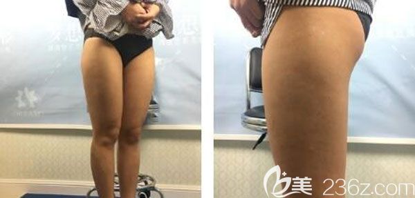 在昆明梦想做吸脂手术前 在昆明梦想做吸脂手术前