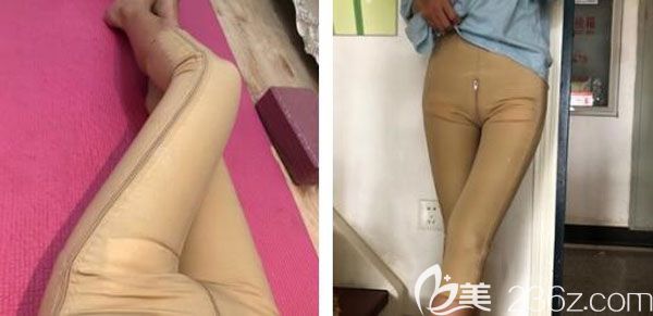 大腿抽脂第9天吸脂的伤口还在慢慢愈合 大腿抽脂第9天吸脂的伤口还在慢慢愈合