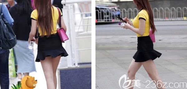  找昆明梦想李成龙做大腿吸脂两个月的效果，终于可以让我朝着模特迈步了