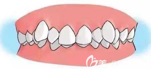 长沙中诺口腔王涪华解答成人牙齿矫正的时间需要多久