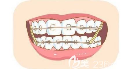 丁建宇医生解答做牙齿矫正的合适年龄 丁建宇医生解答做牙齿矫正的合适年龄