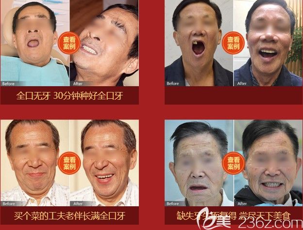长沙中诺立得用全口种植牙及无牙颌种植牙案例效果 长沙中诺立得用全口种植牙及无牙颌种植牙案例效果