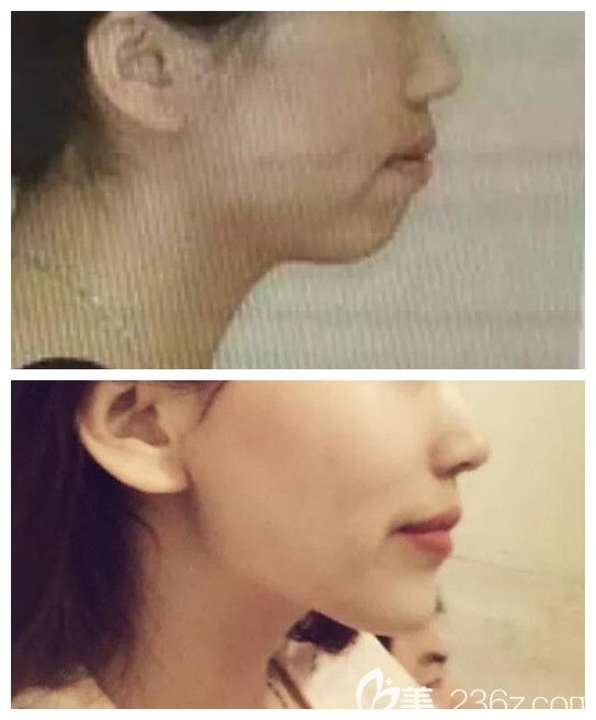 龅牙摘牙套后侧面对比图 龅牙摘牙套后侧面对比图