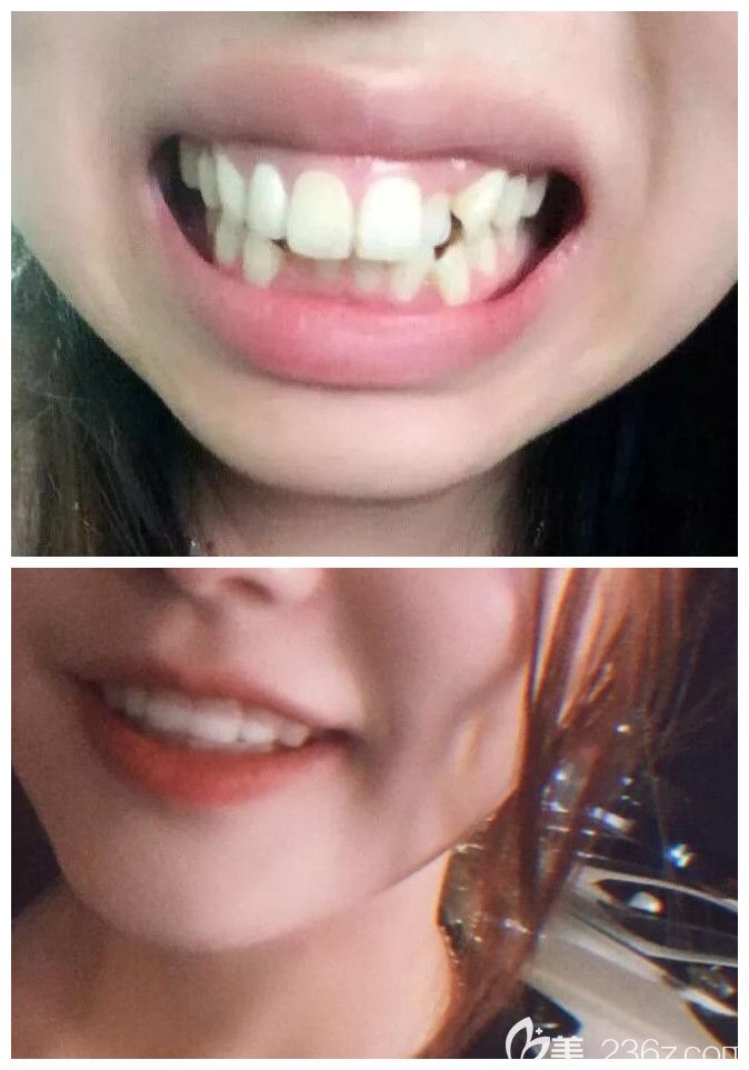 龅牙矫正正面对比凸 龅牙矫正正面对比凸