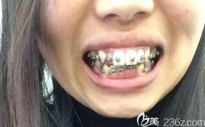 沈阳盛大口腔龅牙矫正初戴牙套样子 沈阳盛大口腔龅牙矫正初戴牙套样子