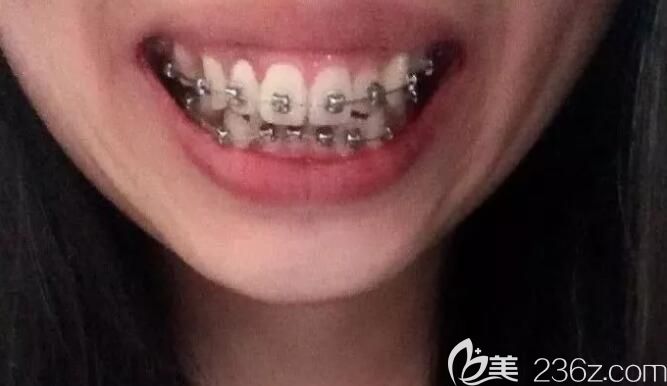 盛大口腔正畸过程中牙齿的变化 盛大口腔正畸过程中牙齿的变化