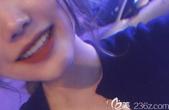 晒晒我在沈阳盛大口腔龅牙矫正后的脸型变化图，妹子们觉得我矫正龅牙后变漂亮了吗