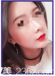 分享我在烟台华怡整形医院隆鼻共30天的恢复过程