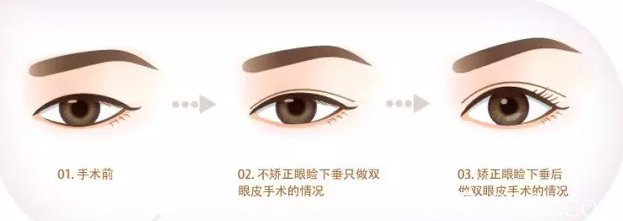 上睑下垂矫正后双眼皮手术效果 上睑下垂矫正后双眼皮手术效果