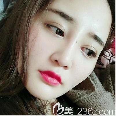 佛山梦露孙文娜医生双眼皮隆鼻<span style=