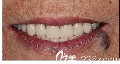 上个月我去长沙中诺做了全口种植牙,感觉立得用种植牙的价格也不坑人,要比长沙公立口腔医院便宜