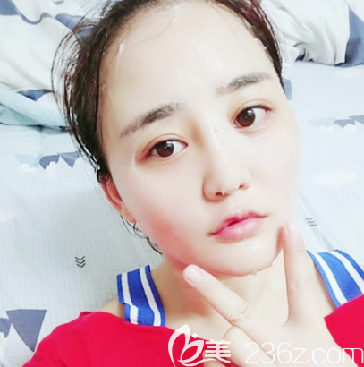 佛山梦露双眼皮隆鼻面部吸脂和祛痘两个月图片