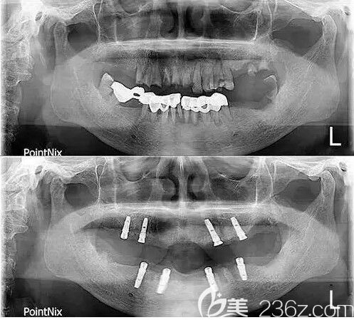 种牙前和种牙后的CT片