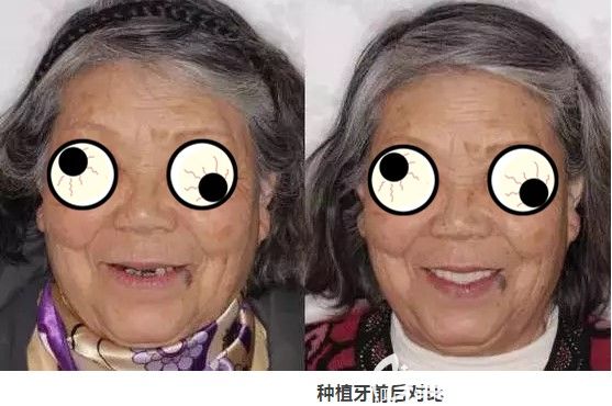 在长沙中诺做过全口种植牙后对比照片 在长沙中诺做过全口种植牙后对比照片