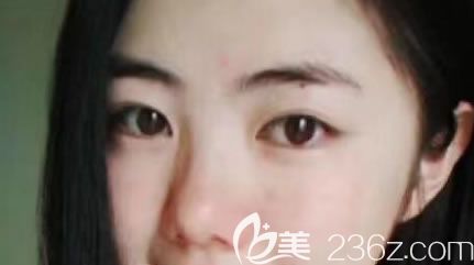 宁波美莱整形做双眼皮手术前 宁波美莱整形做双眼皮手术前