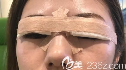 杭州美莱双眼皮即刻 杭州美莱双眼皮即刻