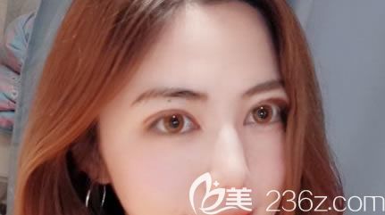 宁波美莱割双眼皮8天照 宁波美莱割双眼皮8天照