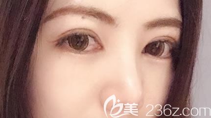 宁波美莱喻正虹双眼皮 宁波美莱喻正虹双眼皮