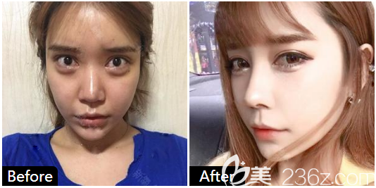 广州<!--<i data=20240703-sp></i>-->做的隆鼻 广州<!--<i data=20240703-sp></i>-->做的隆鼻