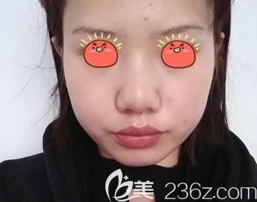 宁波美莱整形做隆鼻手术前 宁波美莱整形做隆鼻手术前