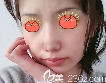 宁波美莱隆鼻案例7天拆线效果 宁波美莱隆鼻案例7天拆线效果