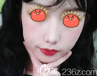 宁波美莱孙明磊隆鼻案例21天效果 宁波美莱孙明磊隆鼻案例21天效果