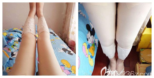刚做完吸脂瘦大腿手术穿着塑身衣 刚做完吸脂瘦大腿手术穿着塑身衣