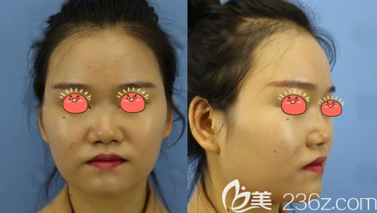 宁波美莱整形做隆鼻术前 宁波美莱整形做隆鼻术前