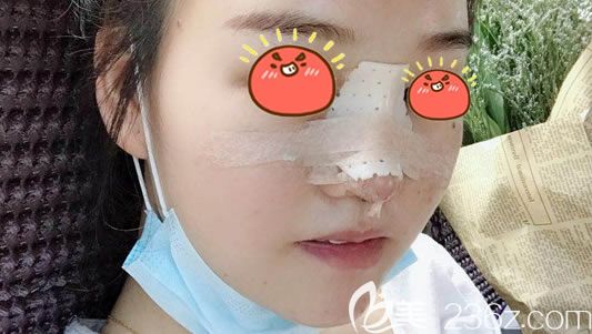 宁波美莱肋软骨隆鼻案例即刻效果 宁波美莱肋软骨隆鼻案例即刻效果