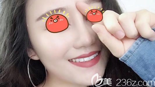 宁波美莱做肋软骨隆鼻7天后 宁波美莱做肋软骨隆鼻7天后