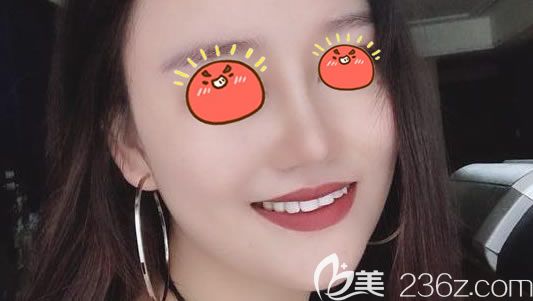 宁波美莱整形鼻综合隆鼻案例 宁波美莱整形鼻综合隆鼻案例