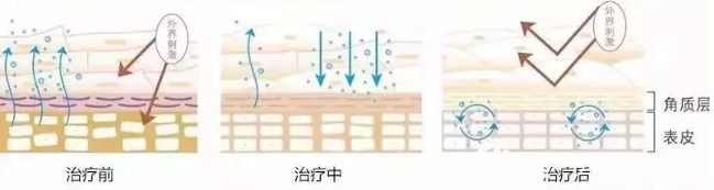 激光去红血丝原理 激光去红血丝原理