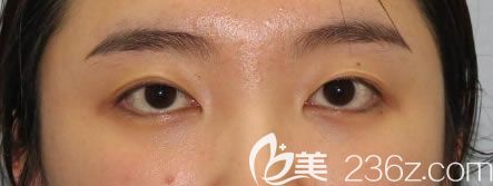 宁波薇琳整形医院做双眼皮术前 宁波薇琳整形医院做双眼皮术前