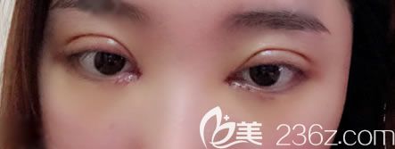 宁波薇琳雷艳莉双眼皮<span style= 宁波薇琳雷艳莉双眼皮<span style=