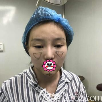 做自体脂肪全脸填充术前画线设计 做自体脂肪全脸填充术前画线设计