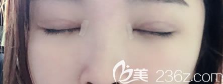 宁波薇琳双眼皮手术疤痕恢复照片 宁波薇琳双眼皮手术疤痕恢复照片