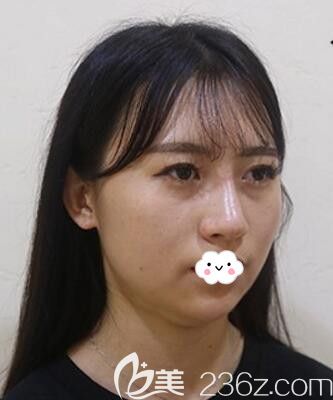 韩国raffine医院下颌缘面部吸脂案例 韩国raffine医院下颌缘面部吸脂案例