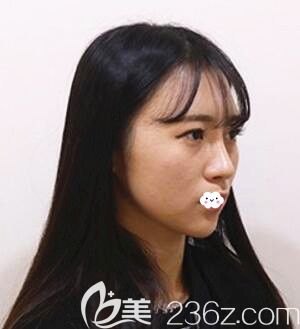 脸部吸脂多久可以见人？不想磨骨瘦脸找韩国raffine医院做下颌缘面部吸脂拥有V脸恢复图见证