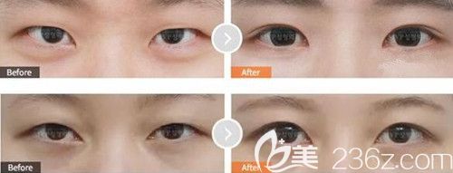 韩国MVP眼部整形案例 韩国MVP眼部整形案例
