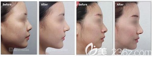 韩国MVP鼻部整形手术案例 韩国MVP鼻部整形手术案例