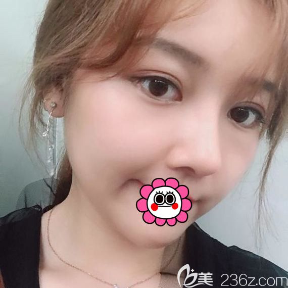 面部条件不错的我找哈尔滨臻美王丹丹做了硅胶隆鼻+自体脂肪填充后五官更加立体