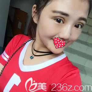 在衡水唯美做双眼皮术后7天进行拆线