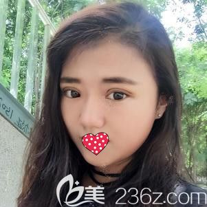 阮念书医生为我做切开双眼皮术后16天慢慢消肿